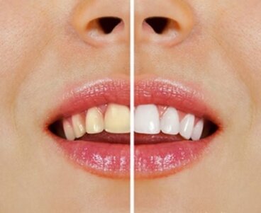 Πώς να λευκάνετε τα δόντια σας με φυσικά προϊόντα