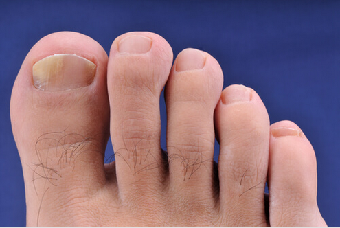 Θεραπείες για την ονυχομυκητίαση στα χέρια και πόδια