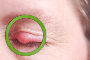 Κριθαράκι (χαλάζιο): Πώς να το θεραπεύσετε γρήγορα