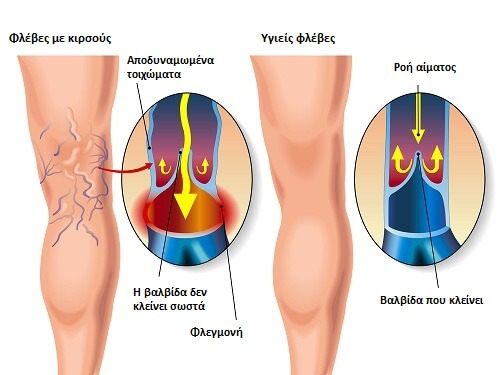 3 απλές και εύκολες ασκήσεις για τους κιρσούς