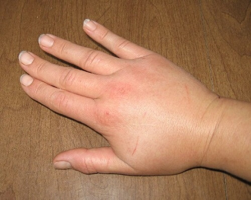 Αφεψήματα που μειώνουν την κατακράτηση υγρών