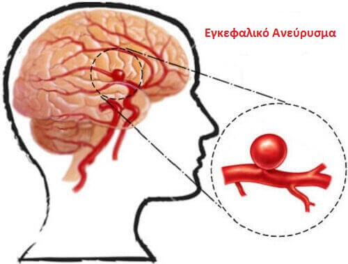 Εγκεφαλικό ανεύρυσμα: Τι είναι και πώς να το εμποδίσετε