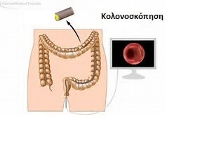 Έγκαιρη ανίχνευση του καρκίνου του παχέος εντέρου