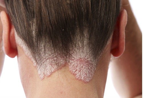 Θεραπείες για την καταπολέμηση της πιτυρίδας