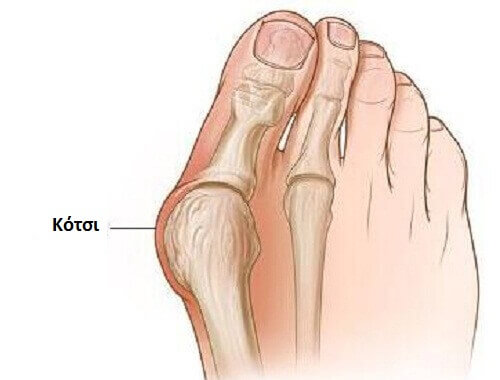 Γιατί σχηματίζονται τα κότσια και πώς αντιμετωπίζονται