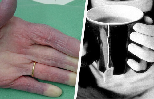 Κρύα χέρια: οι πιθανές αιτίες και αντιμετώπιση