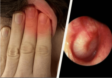 Πώς να θεραπεύσετε τις μολύνσεις των αυτιών