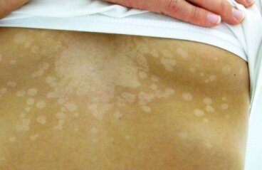Ενδείξεις στο δέρμα για πιθανά προβλήματα υγείας