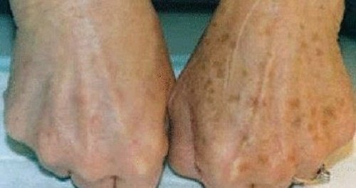Κηλίδες στα χέρια: πώς να τις μειώσετε φυσικά
