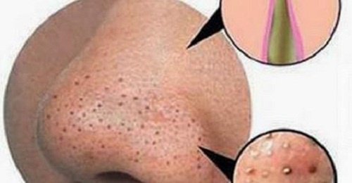 Απαλλαγείτε από σπυράκια και τα μαύρα στίγματα