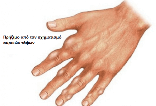 Πώς να μειώσετε το ουρικό οξύ με σπιτικές θεραπείες