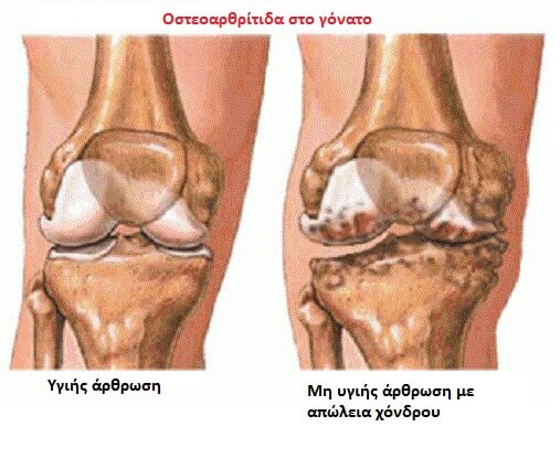Συμπτώματα και πρόληψη της αρθρίτιδας