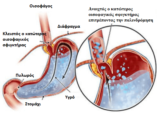Περιορίστε τα συμπτώματα της παλινδρόμησης