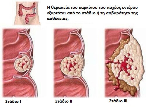 Τι πρέπει να ξέρετε για τον καρκίνο του παχέος εντέρου