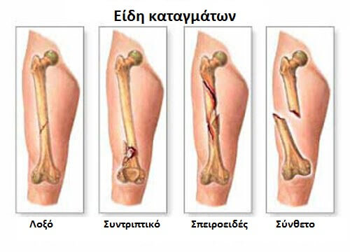 Συμπτώματα για τον πρωτογενή καρκίνο των οστών