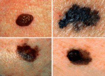 Μάθετε πώς να ανιχνεύετε τον πιθανό καρκίνο του δέρματος