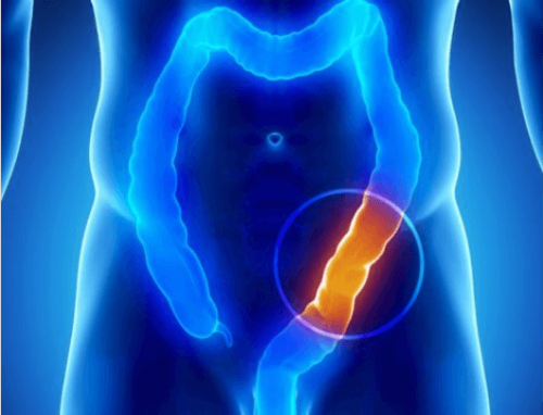 Το 90% των ασθενειών περιλαμβάνουν ένα μη υγιές παχύ έντερο