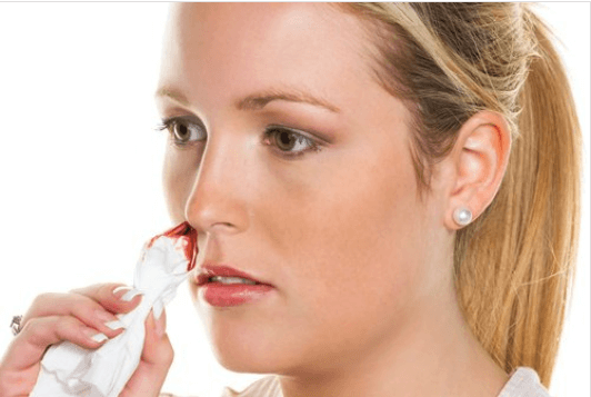 Φυσικές θεραπείες για τη ρινορραγία. Δοκιμάστε τες.