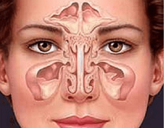 Αντιμετωπίστε την ιγμορίτιδα με φυσικό τρόπο