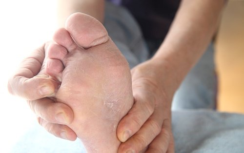 Πόδι του αθλητή: πρόληψη και αντιμετώπιση