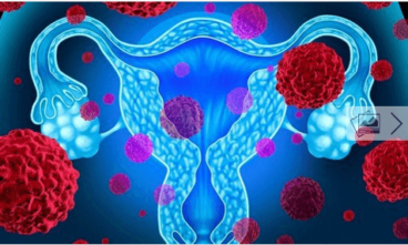 Καρκίνος του ενδομητρίου: 5 πράγματα που πρέπει να γνωρίζετε