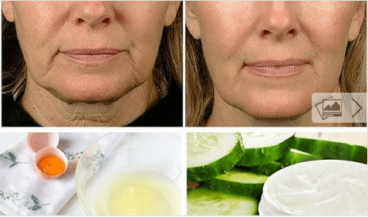 5 θεραπείες για την καταπολέμηση της χαλάρωσης του προσώπου