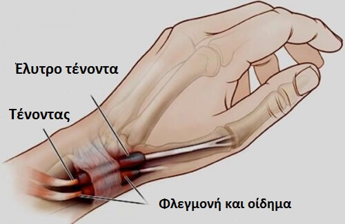 Αίτια και συμπτώματα της τενοντοελυτρίτιδας!