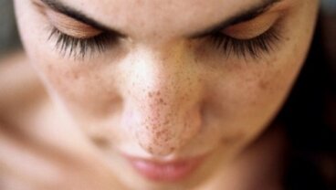 Σκούρες κηλίδες στο πρόσωπο: 6 θεραπείες για να απαλλαγείτε!