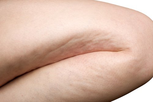 6 ασκήσεις για να καταπολεμήσετε την κυτταρίτιδα