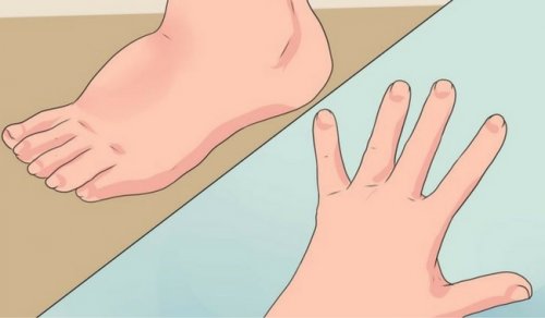 Κατακράτηση νερού: 5 τρόποι για να την αντιμετωπίσετε