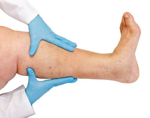 3 συστάσεις για να ελέγξετε την κατακράτηση υγρών