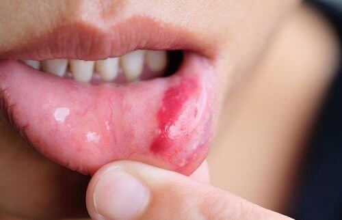 Καρκίνος του στόματος: συμπτώματα και πρόληψη