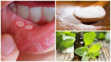 Άφθες στο στόμα: 7 σπιτικές θεραπείες για γρήγορη επούλωση