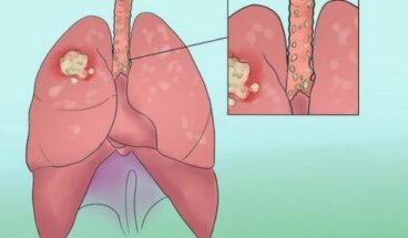 8 σημάδια του καρκίνου του πνεύμονα που πρέπει να ξέρετε