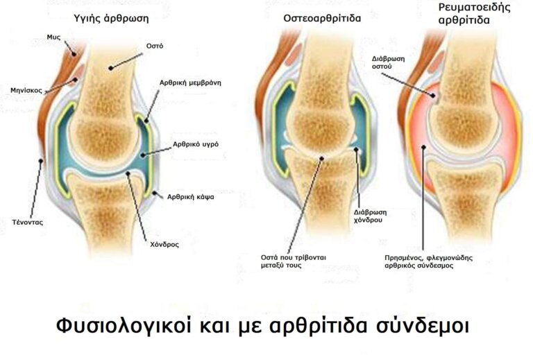 Διαφορές ανάμεσα στην αρθρίτιδα και την οστεοαρθρίτιδα