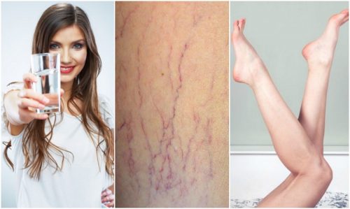 Διαβάστε τις 6 συμβουλές για ν' αποτρέψετε τους κιρσούς