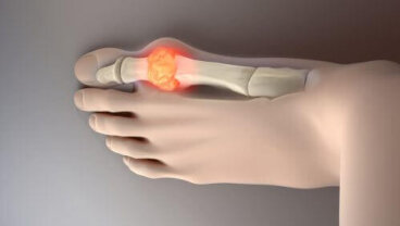 Δοκιμάστε 8 ιδανικές τροφές για να μειώσετε το ουρικό οξύ