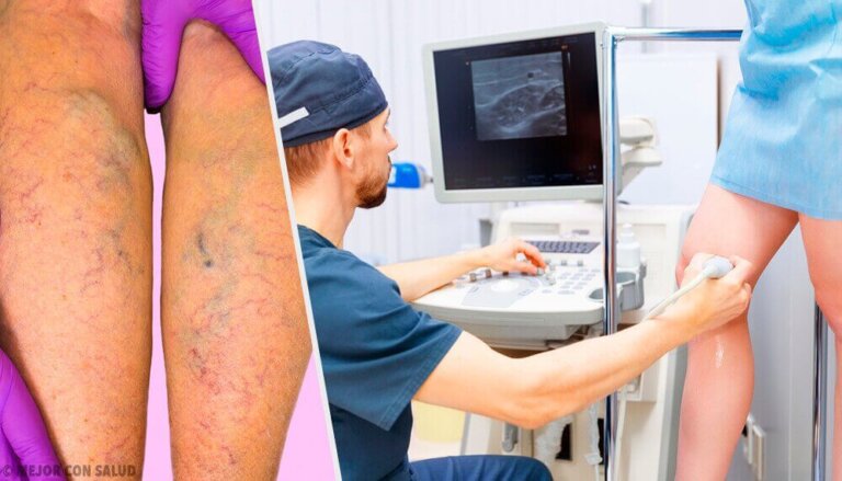 Φυσικές και από στόματος θεραπείες για τους κιρσούς