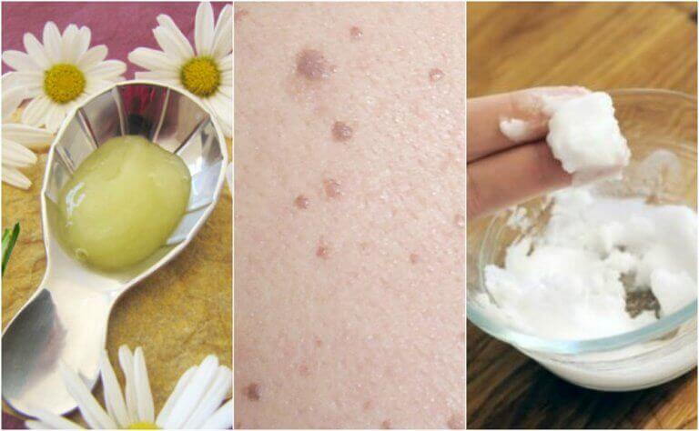 Πέντε θεραπείες για την εξάλειψη των κονδυλωμάτων