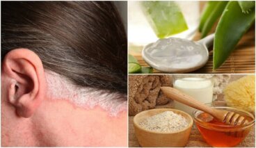 5 θεραπείες για την ψωρίαση του τριχωτού της κεφαλής