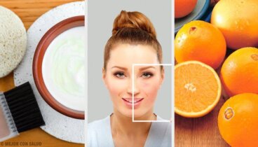 Φυσικοί τρόποι για ν' απαλλαγείτε από τις ατέλειες του δέρματος