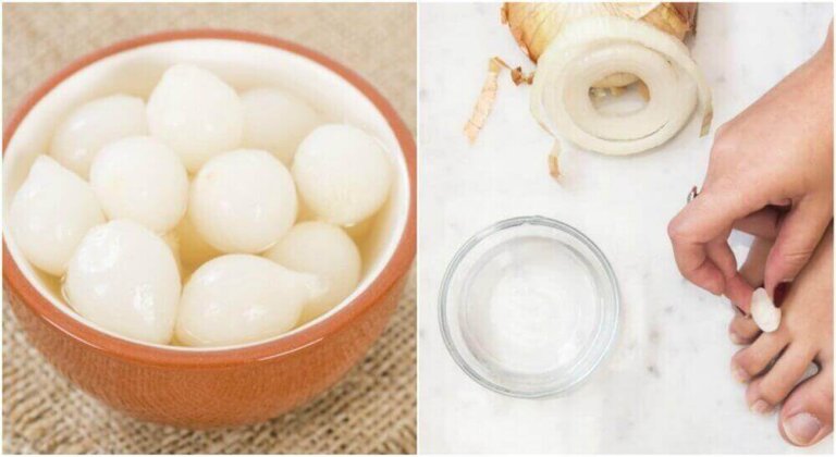 Απαλλαγείτε από τους κάλους στα πόδια με ένα φυσικό διάλυμα