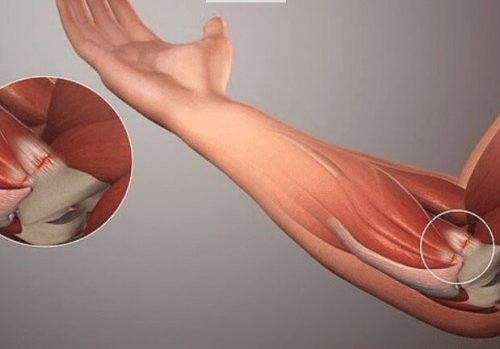 Τρόποι αντιμετώπισης της τενοντίτιδας και αιτίες