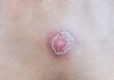 Τι είναι ο καλόγερος; 7 κόλπα για να τον ξεφορτωθείτε