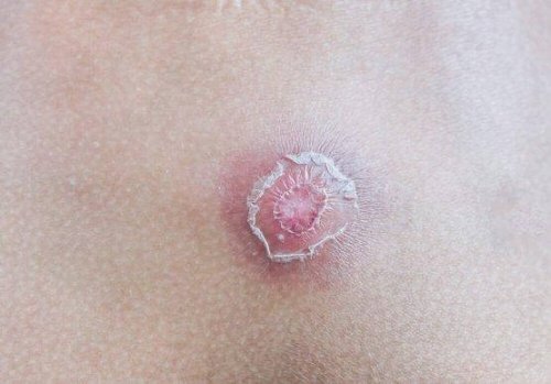 Τι είναι ο καλόγερος; 7 κόλπα για να τον ξεφορτωθείτε