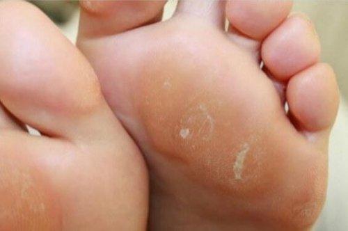 Κρεμμύδι και λευκό ξίδι: Η καλύτερη θεραπεία για τους κάλους στα πόδια