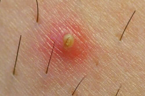 Είσφρυση τριχών: πώς να την αποτρέψετε