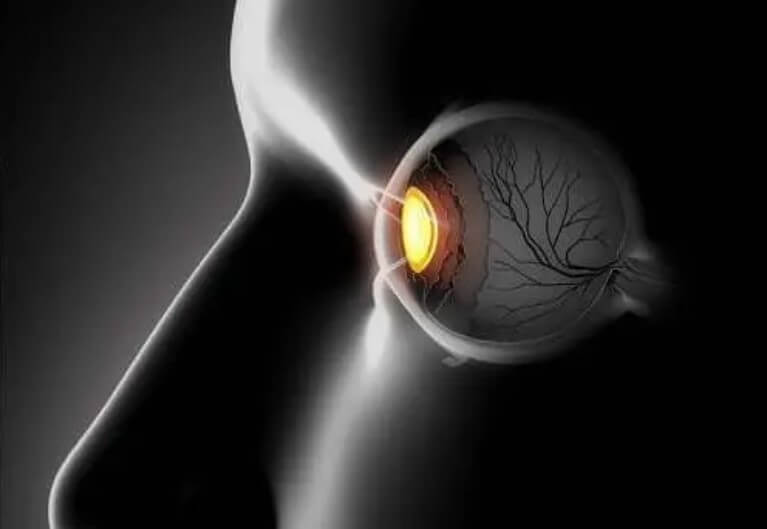 Αλλήθωρα μάτια: Συμπτώματα και θεραπείες