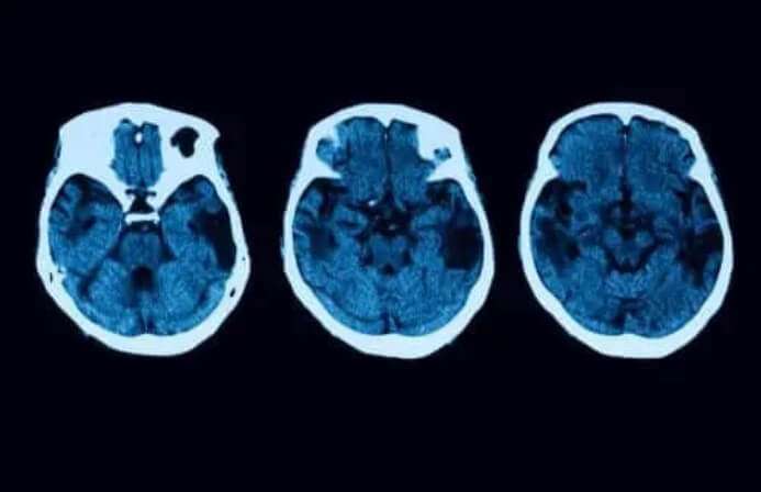 Φλοιώδης ατροφία: Διάγνωση και θεραπεία