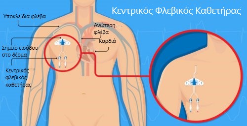 Αγγειακή διάτρηση και κεντρικοί φλεβικοί καθετήρες